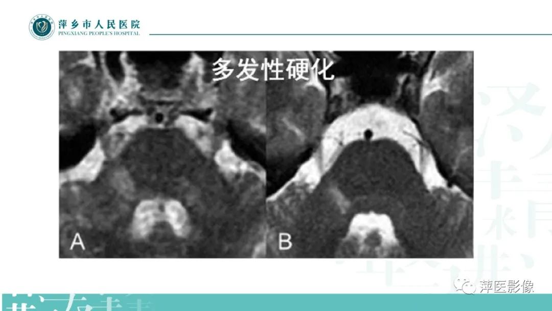 影像PPT - 【PPT】三叉神经痛-22