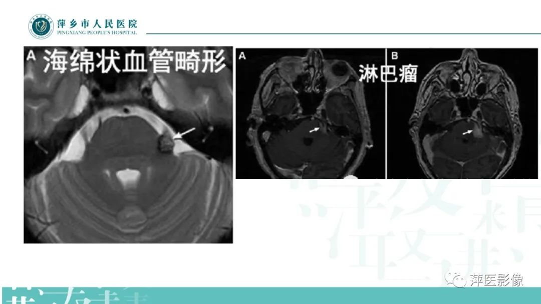 影像PPT - 【PPT】三叉神经痛-23