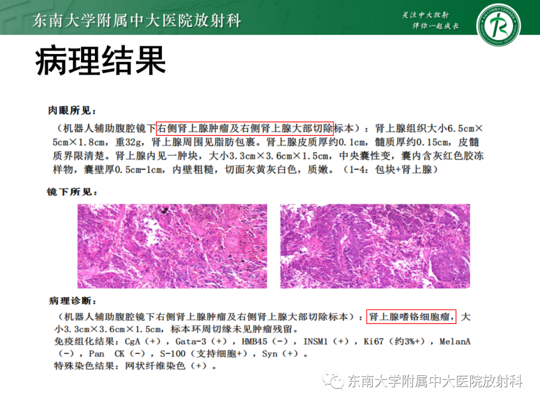 影像PPT - 【PPT】肾上腺嗜铬细胞瘤-3 影像PPT - 【PPT】肾上腺嗜铬细胞瘤-3