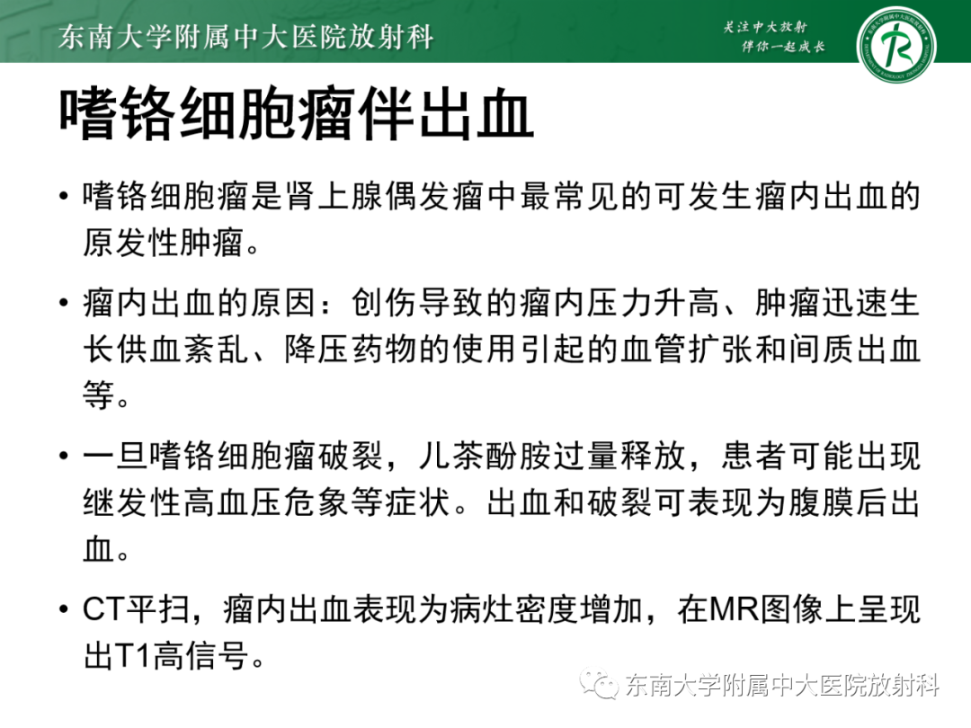 影像PPT - 【PPT】肾上腺嗜铬细胞瘤-14 影像PPT - 【PPT】肾上腺嗜铬细胞瘤-14