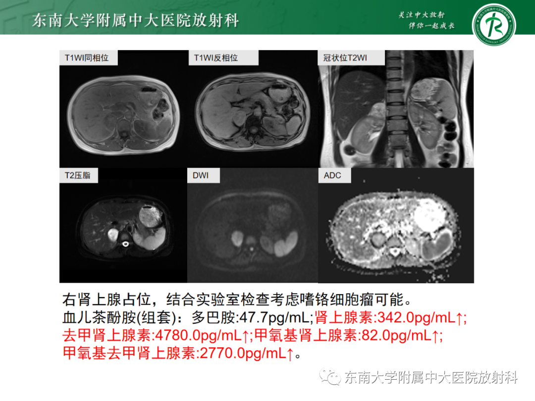 影像PPT - 【PPT】肾上腺嗜铬细胞瘤-16 影像PPT - 【PPT】肾上腺嗜铬细胞瘤-16