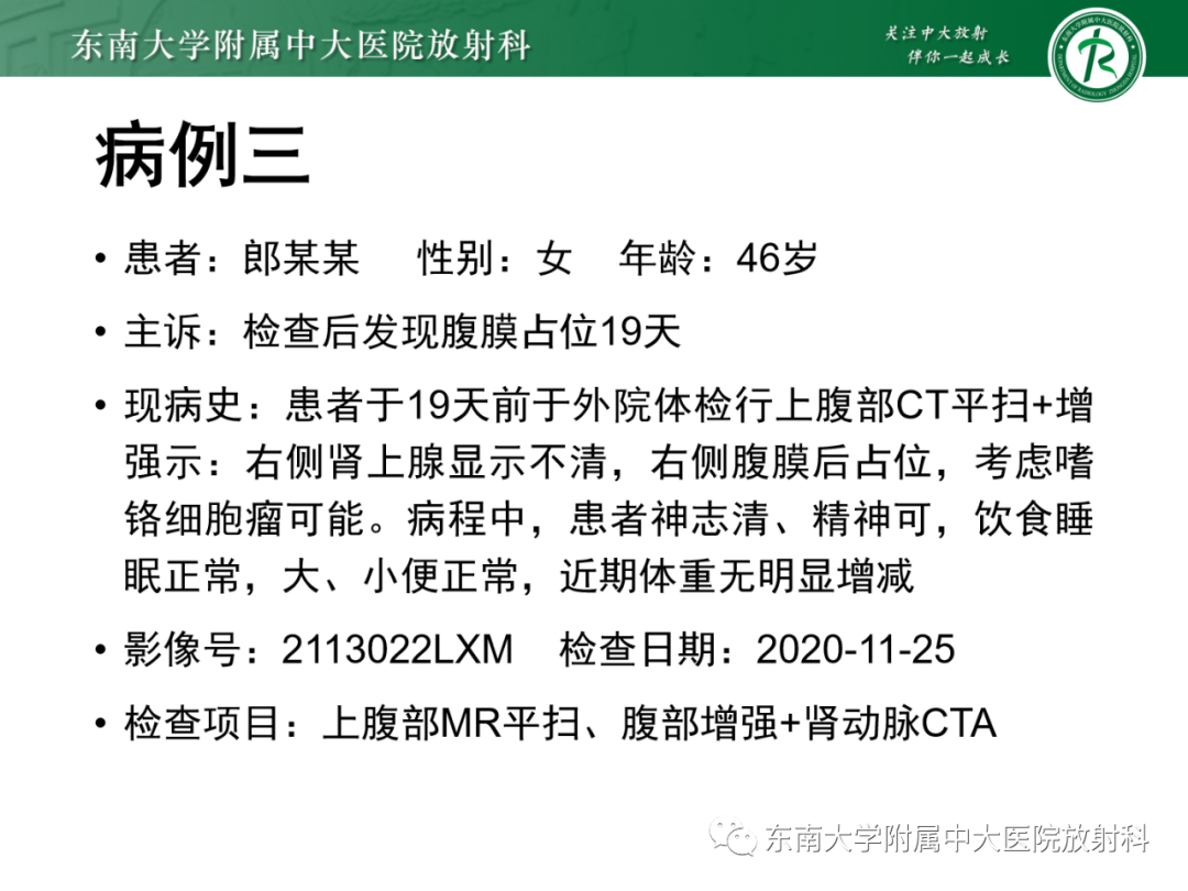 影像PPT - 【PPT】肾上腺嗜铬细胞瘤-18 影像PPT - 【PPT】肾上腺嗜铬细胞瘤-18