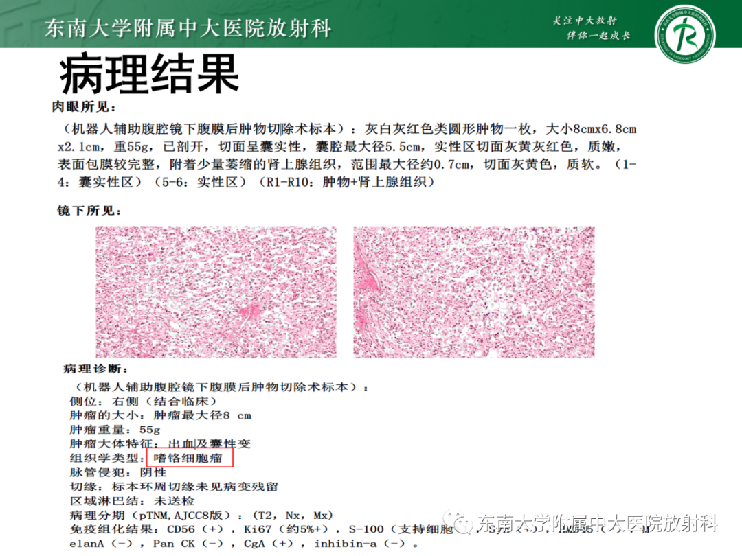 影像PPT - 【PPT】肾上腺嗜铬细胞瘤-20 影像PPT - 【PPT】肾上腺嗜铬细胞瘤-20
