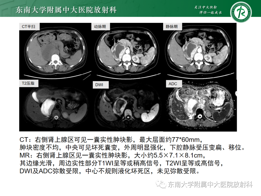 影像PPT - 【PPT】肾上腺嗜铬细胞瘤-19 影像PPT - 【PPT】肾上腺嗜铬细胞瘤-19