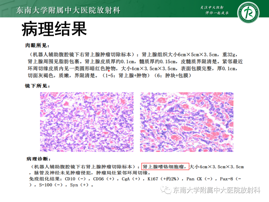 影像PPT - 【PPT】肾上腺嗜铬细胞瘤-17 影像PPT - 【PPT】肾上腺嗜铬细胞瘤-17