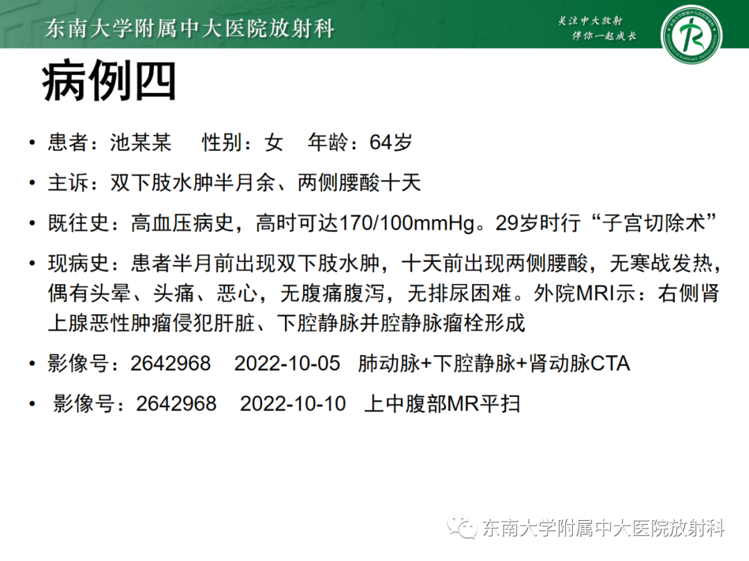 影像PPT - 【PPT】肾上腺嗜铬细胞瘤-25 影像PPT - 【PPT】肾上腺嗜铬细胞瘤-25