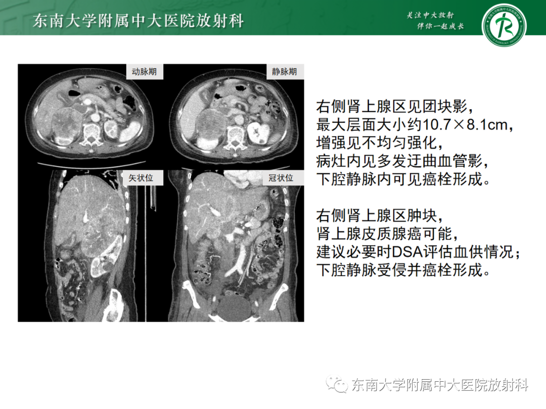 影像PPT - 【PPT】肾上腺嗜铬细胞瘤-26 影像PPT - 【PPT】肾上腺嗜铬细胞瘤-26