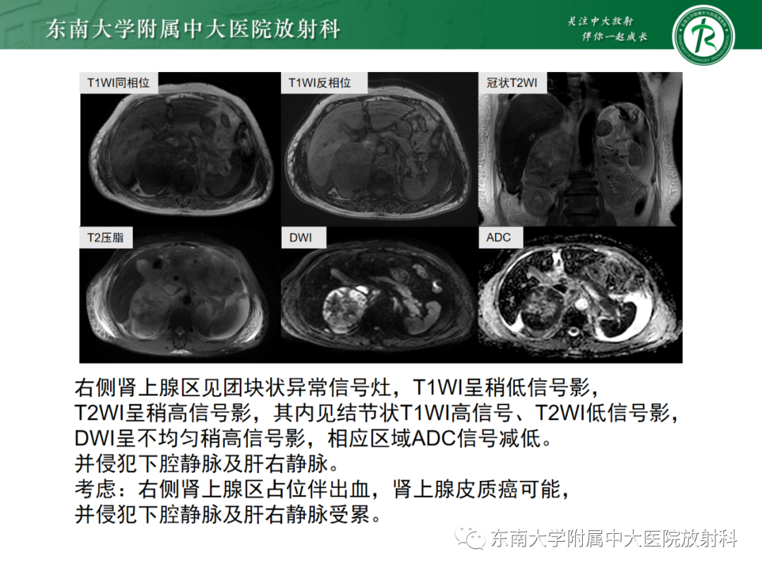 影像PPT - 【PPT】肾上腺嗜铬细胞瘤-27 影像PPT - 【PPT】肾上腺嗜铬细胞瘤-27