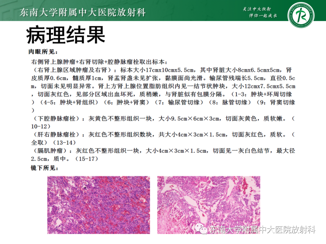 影像PPT - 【PPT】肾上腺嗜铬细胞瘤-28 影像PPT - 【PPT】肾上腺嗜铬细胞瘤-28
