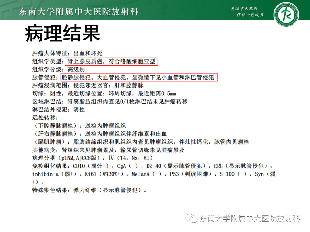 影像PPT - 【PPT】肾上腺嗜铬细胞瘤-29 影像PPT - 【PPT】肾上腺嗜铬细胞瘤-29
