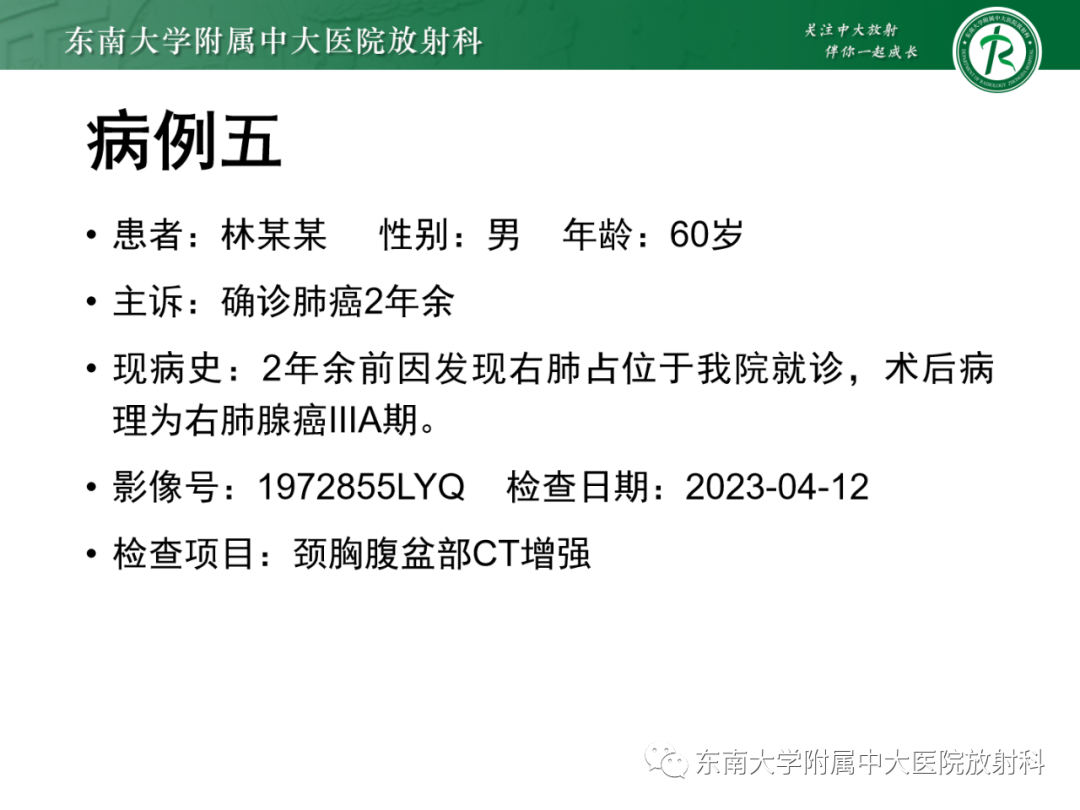 影像PPT - 【PPT】肾上腺嗜铬细胞瘤-31 影像PPT - 【PPT】肾上腺嗜铬细胞瘤-31