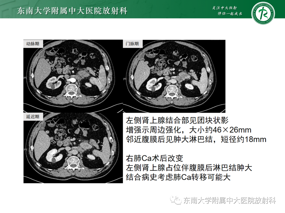 影像PPT - 【PPT】肾上腺嗜铬细胞瘤-32 影像PPT - 【PPT】肾上腺嗜铬细胞瘤-32