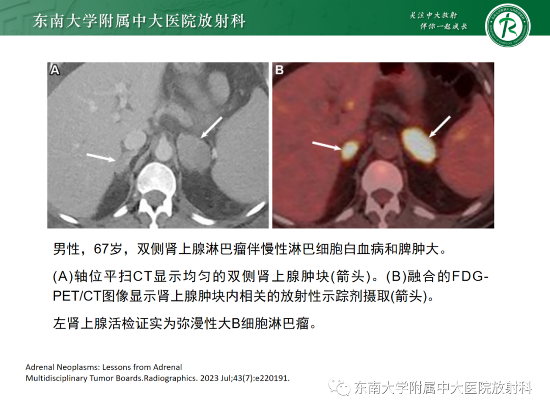 影像PPT - 【PPT】肾上腺嗜铬细胞瘤-34 影像PPT - 【PPT】肾上腺嗜铬细胞瘤-34