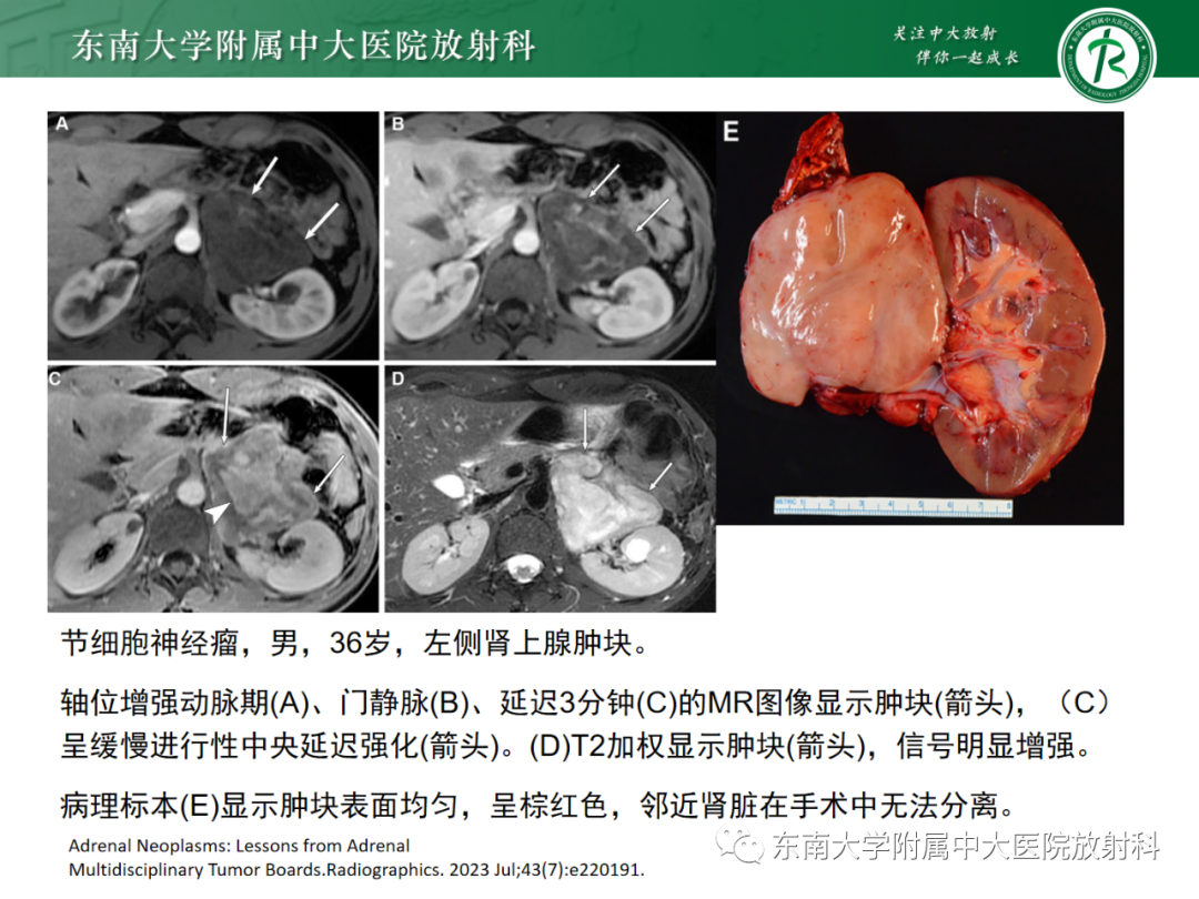 影像PPT - 【PPT】肾上腺嗜铬细胞瘤-36 影像PPT - 【PPT】肾上腺嗜铬细胞瘤-36