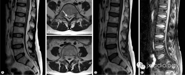 影像PPT - 硬膜外脂肪增多症(Spinal Epidural Lipomatosis,SEL)-1 影像PPT - 硬膜外脂肪增多症(Spinal Epidural Lipomatosis,SEL)-1