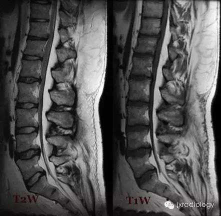 影像PPT - 硬膜外脂肪增多症(Spinal Epidural Lipomatosis,SEL)-2 影像PPT - 硬膜外脂肪增多症(Spinal Epidural Lipomatosis,SEL)-2