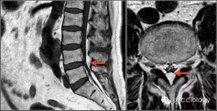 影像PPT - 硬膜外脂肪增多症(Spinal Epidural Lipomatosis,SEL)-4 影像PPT - 硬膜外脂肪增多症(Spinal Epidural Lipomatosis,SEL)-4