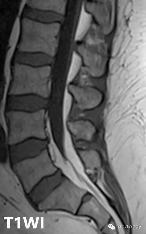 影像PPT - 硬膜外脂肪增多症(Spinal Epidural Lipomatosis,SEL)-5 影像PPT - 硬膜外脂肪增多症(Spinal Epidural Lipomatosis,SEL)-5