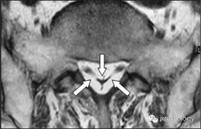 影像PPT - 硬膜外脂肪增多症(Spinal Epidural Lipomatosis,SEL)-6 影像PPT - 硬膜外脂肪增多症(Spinal Epidural Lipomatosis,SEL)-6