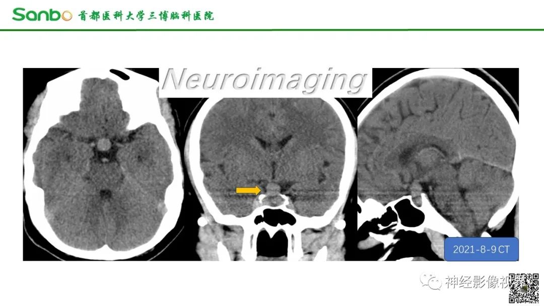 影像PPT - 【病例】垂体增生1例CT及MR影像-1 影像PPT - 【病例】垂体增生1例CT及MR影像-1