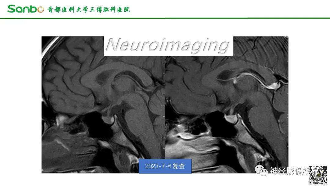 影像PPT - 【病例】垂体增生1例CT及MR影像-8 影像PPT - 【病例】垂体增生1例CT及MR影像-8