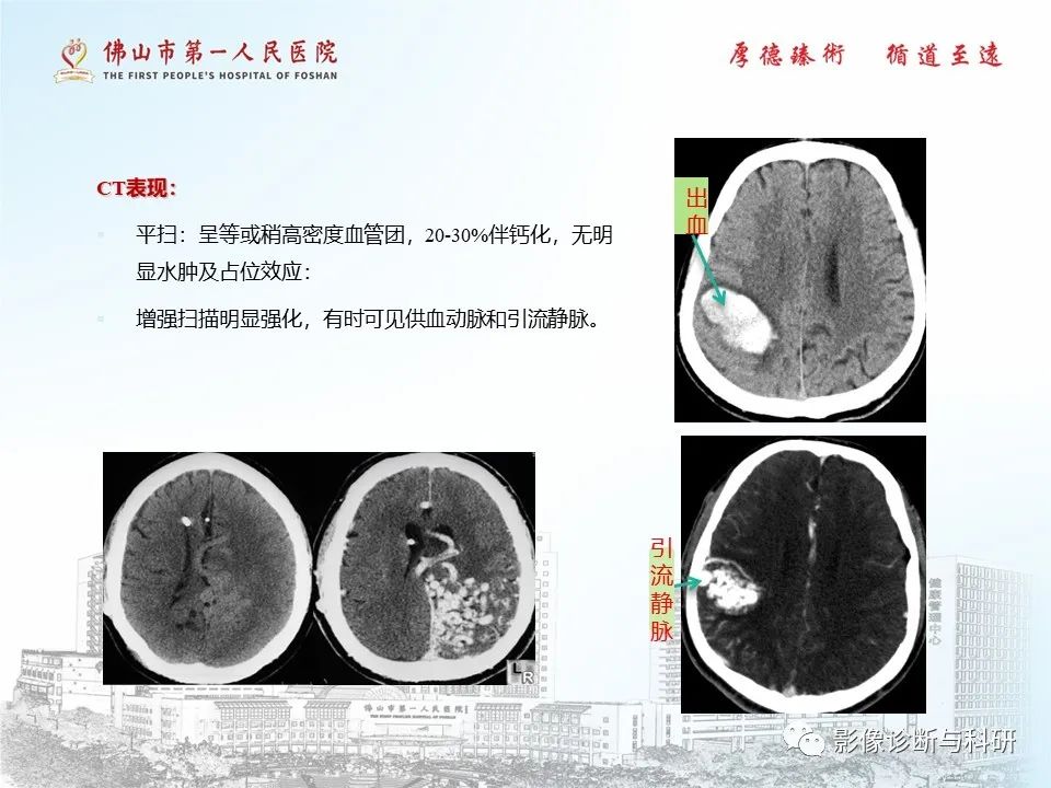 影像PPT - 【PPT】脑血管畸形的影像诊断-5