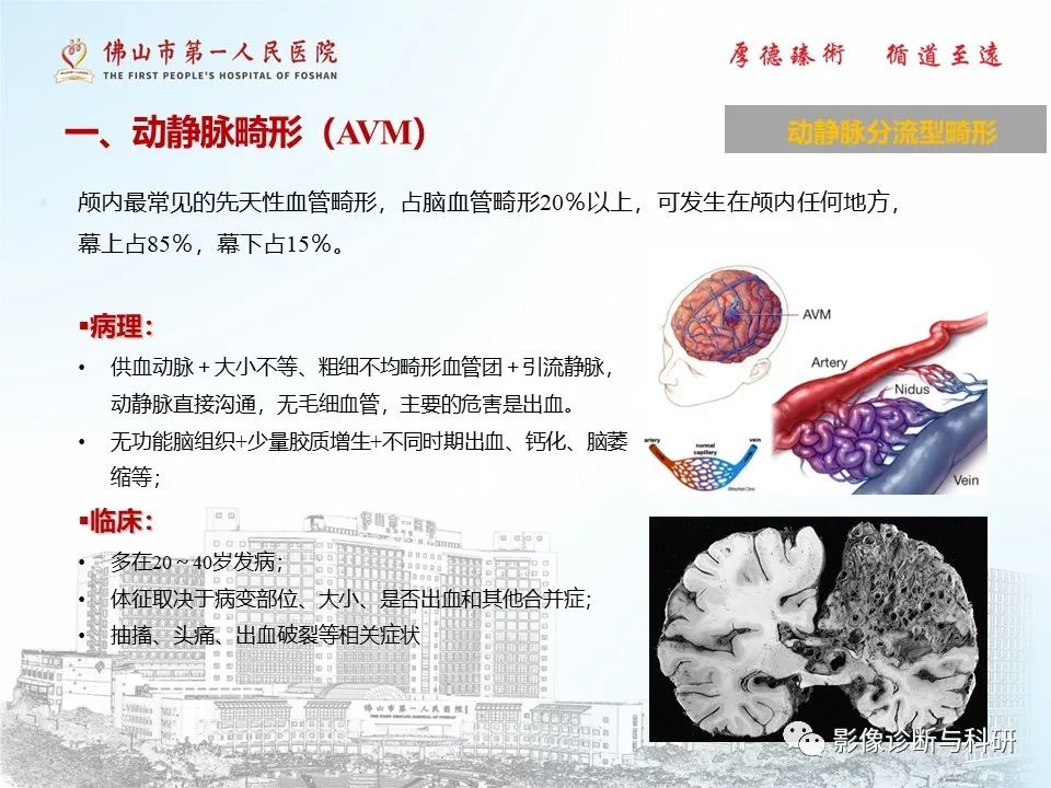 影像PPT - 【PPT】脑血管畸形的影像诊断-4