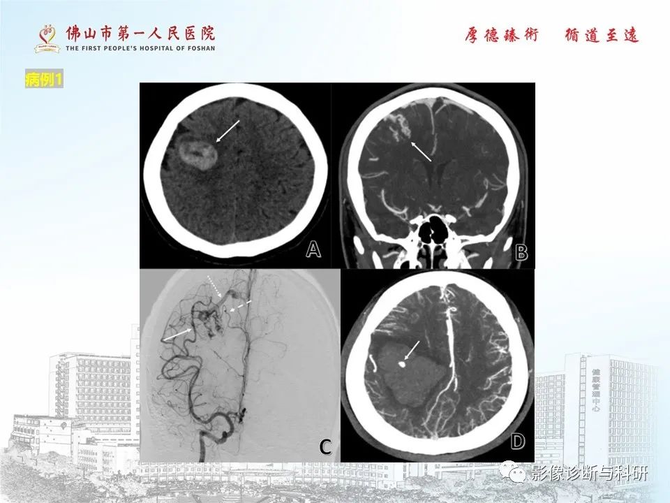 影像PPT - 【PPT】脑血管畸形的影像诊断-6