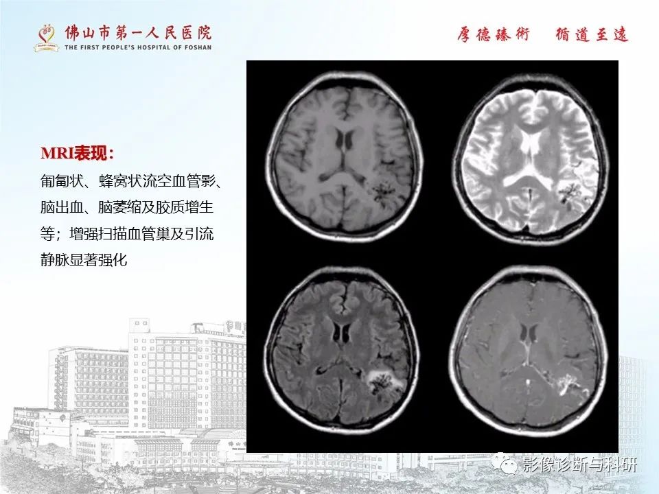 影像PPT - 【PPT】脑血管畸形的影像诊断-7