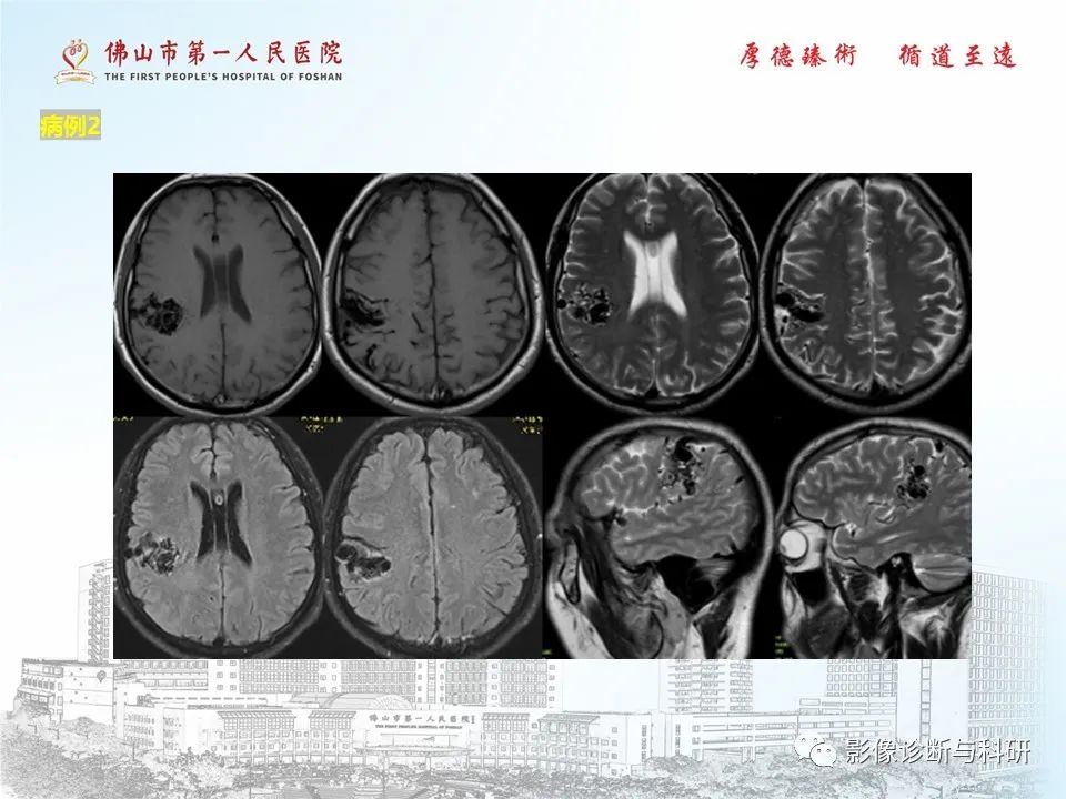 影像PPT - 【PPT】脑血管畸形的影像诊断-8