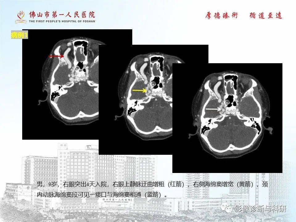 影像PPT - 【PPT】脑血管畸形的影像诊断-12