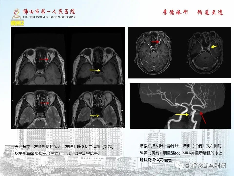 影像PPT - 【PPT】脑血管畸形的影像诊断-13