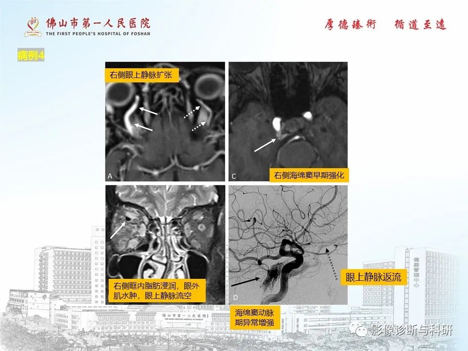 影像PPT - 【PPT】脑血管畸形的影像诊断-15