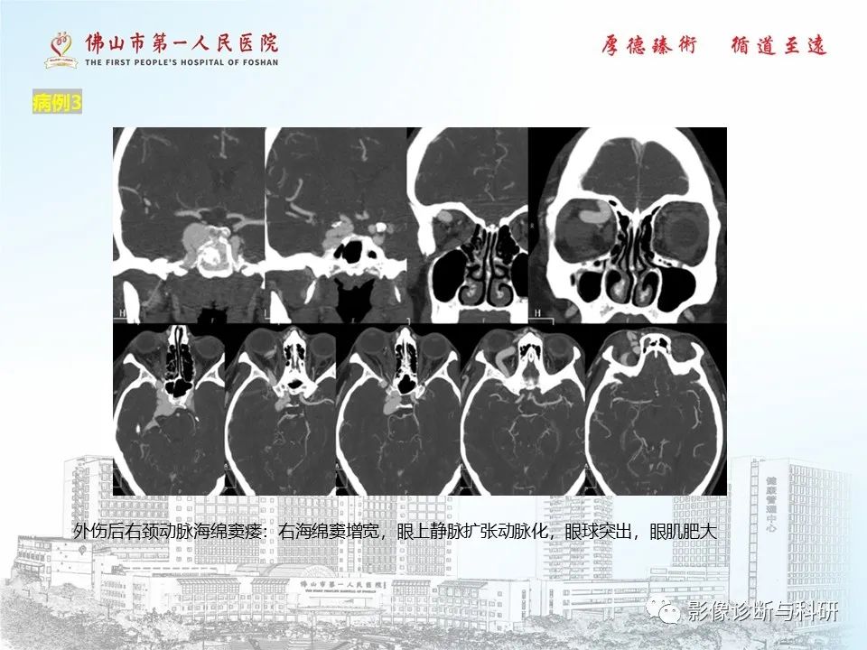 影像PPT - 【PPT】脑血管畸形的影像诊断-14