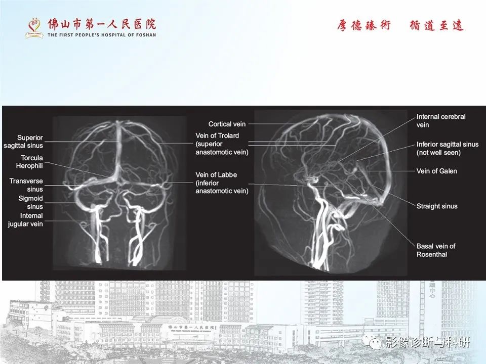 影像PPT - 【PPT】脑血管畸形的影像诊断-17