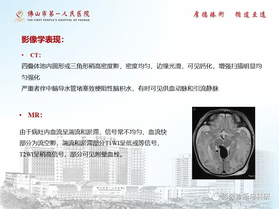 影像PPT - 【PPT】脑血管畸形的影像诊断-18