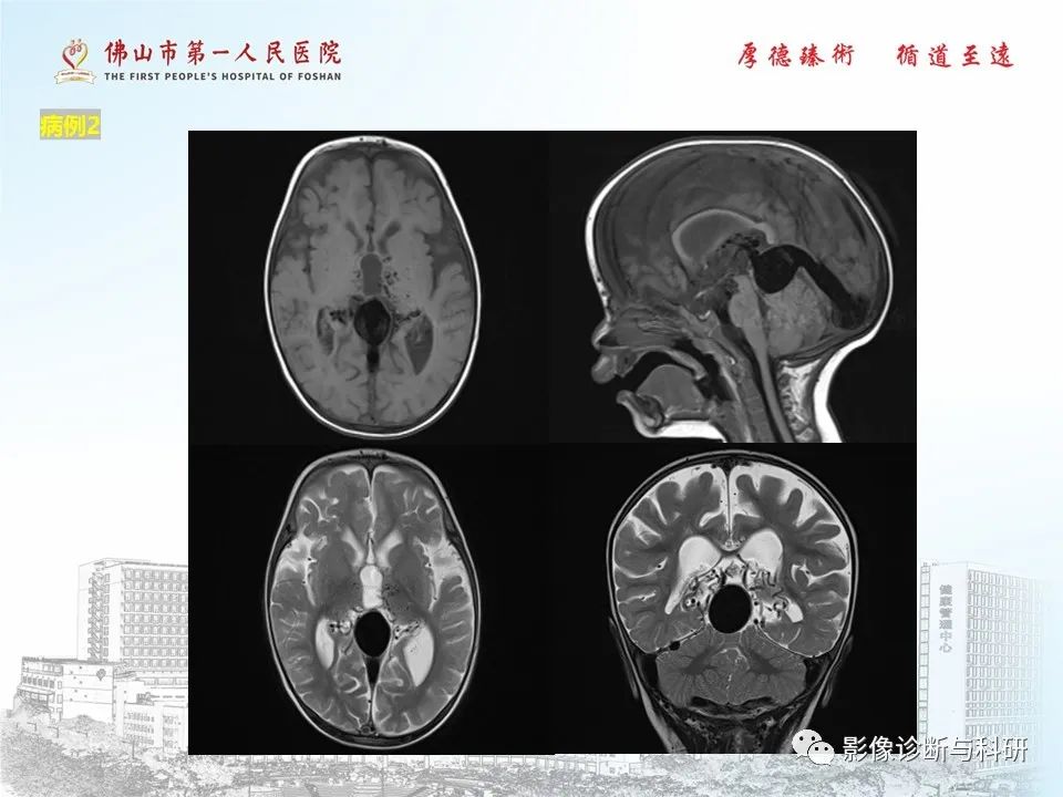 影像PPT - 【PPT】脑血管畸形的影像诊断-20