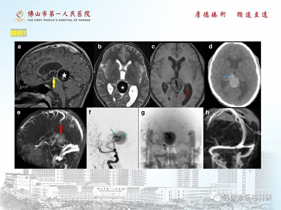 影像PPT - 【PPT】脑血管畸形的影像诊断-19