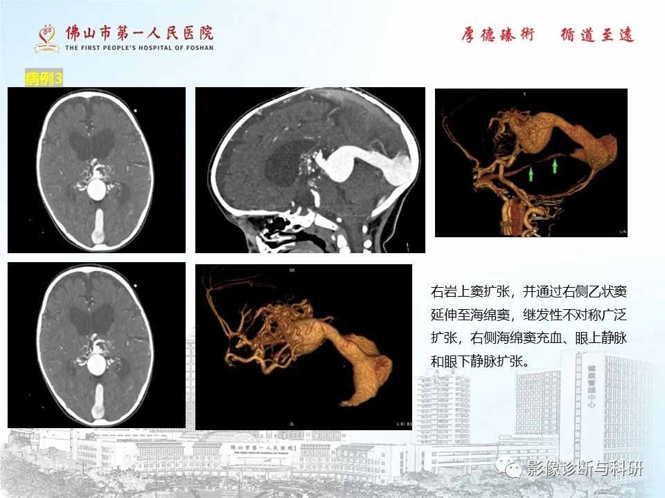 影像PPT - 【PPT】脑血管畸形的影像诊断-21