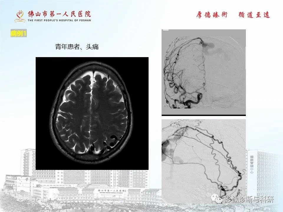 影像PPT - 【PPT】脑血管畸形的影像诊断-26