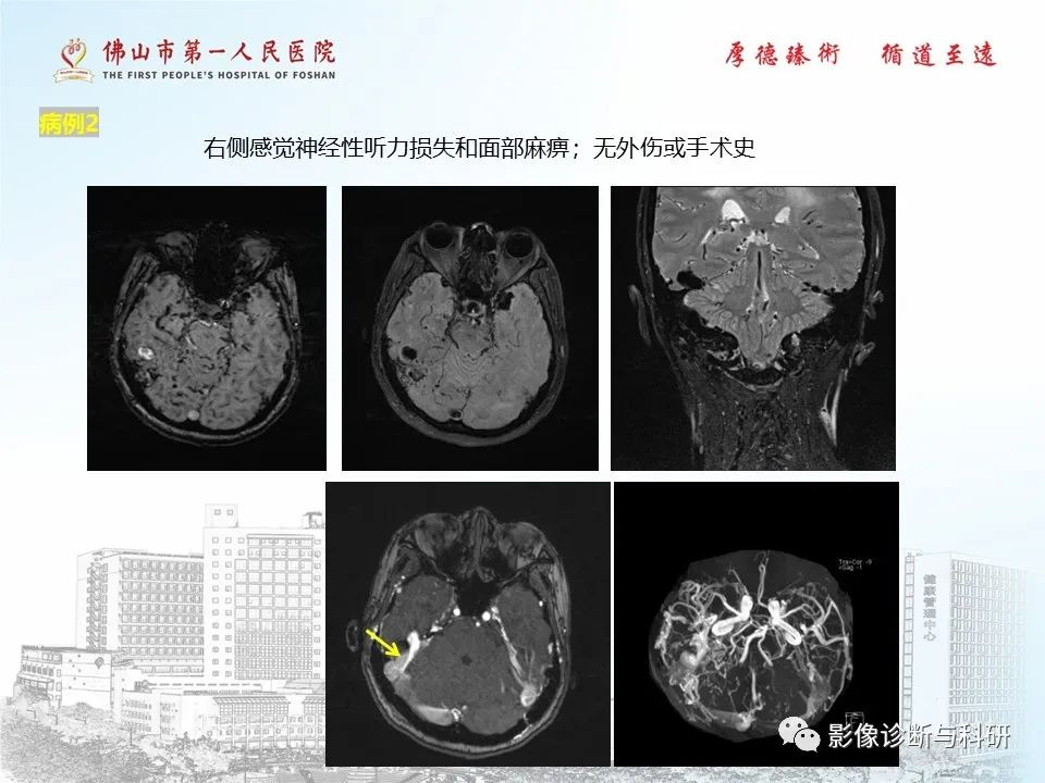 影像PPT - 【PPT】脑血管畸形的影像诊断-27