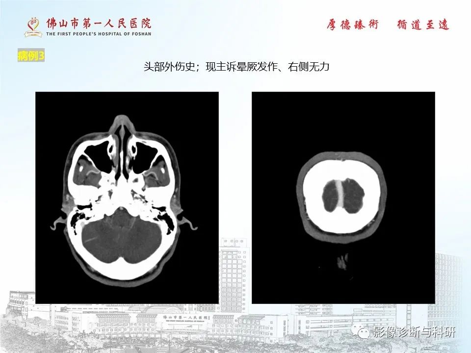影像PPT - 【PPT】脑血管畸形的影像诊断-29