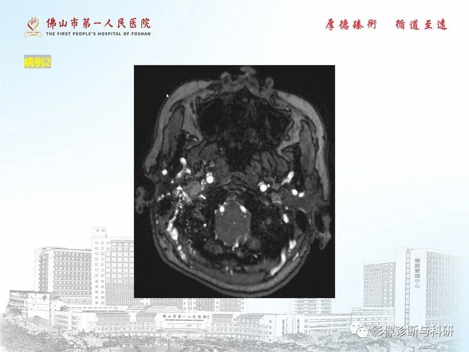 影像PPT - 【PPT】脑血管畸形的影像诊断-28