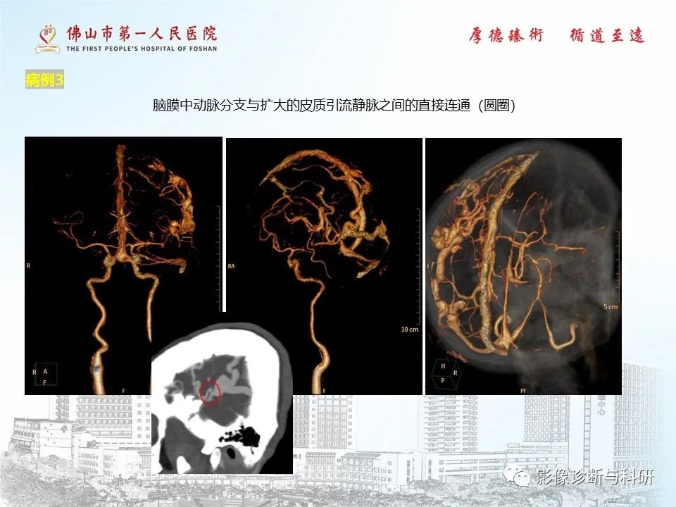 影像PPT - 【PPT】脑血管畸形的影像诊断-30