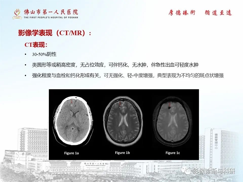 影像PPT - 【PPT】脑血管畸形的影像诊断-32