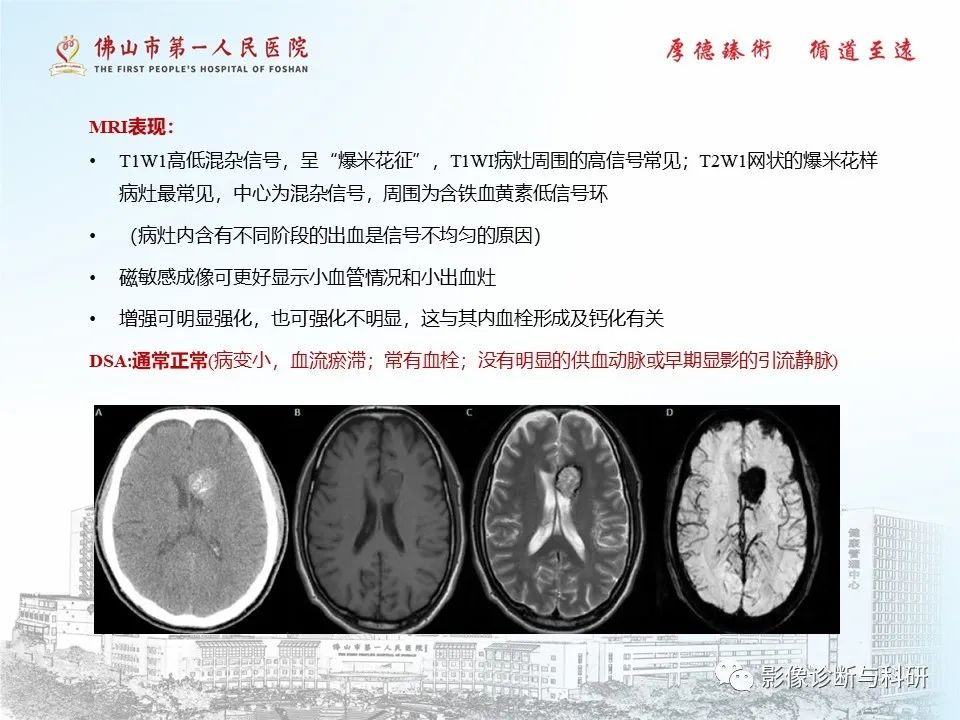 影像PPT - 【PPT】脑血管畸形的影像诊断-33