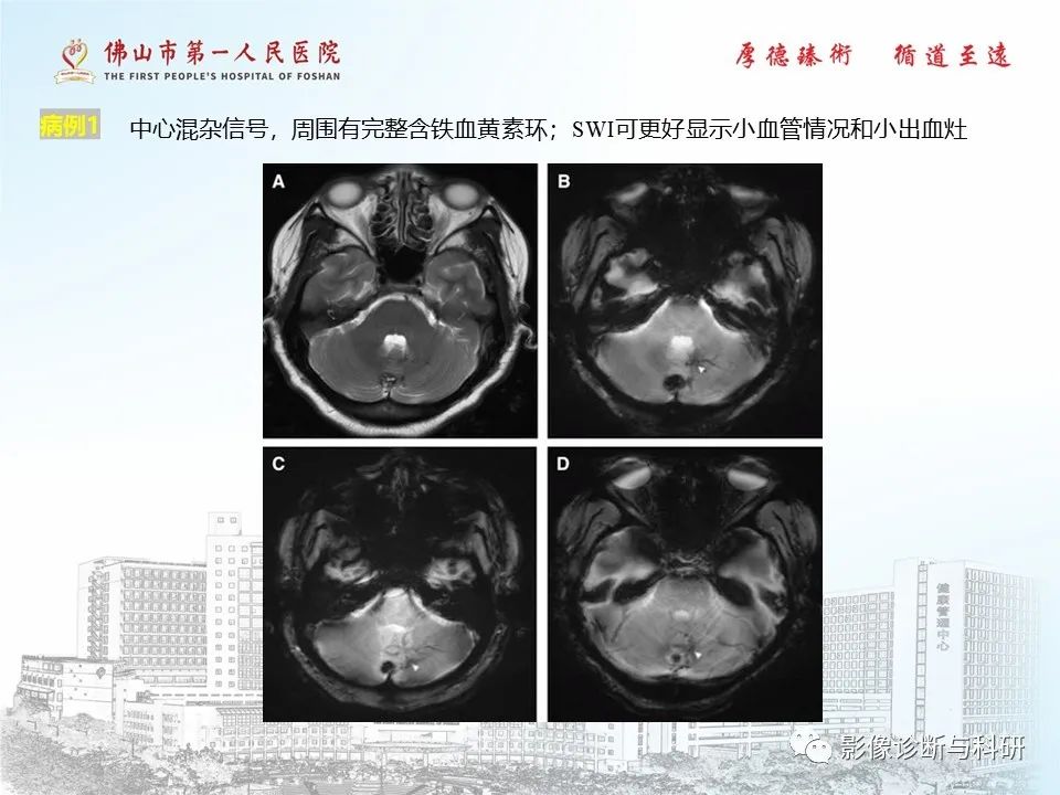 影像PPT - 【PPT】脑血管畸形的影像诊断-34
