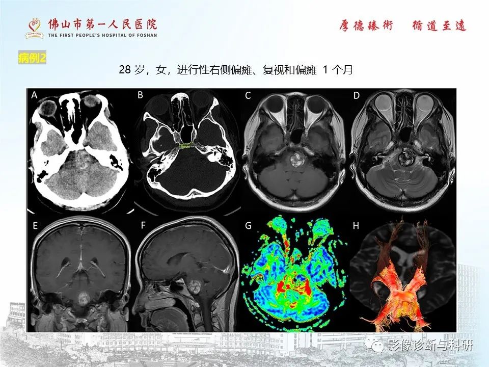 影像PPT - 【PPT】脑血管畸形的影像诊断-35