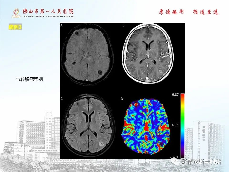影像PPT - 【PPT】脑血管畸形的影像诊断-36