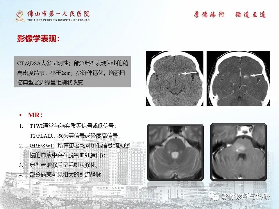 影像PPT - 【PPT】脑血管畸形的影像诊断-38